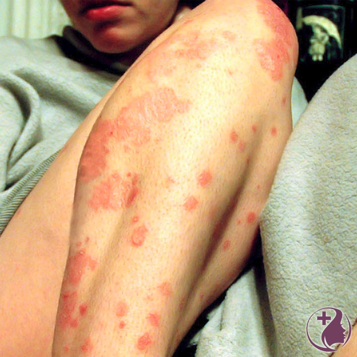 Ugh! Red, itchy, scaly and dry patches of skin. Don’t suffer any longer and discover how to treat psoriasis naturally with these secret essential oil blend remedies.